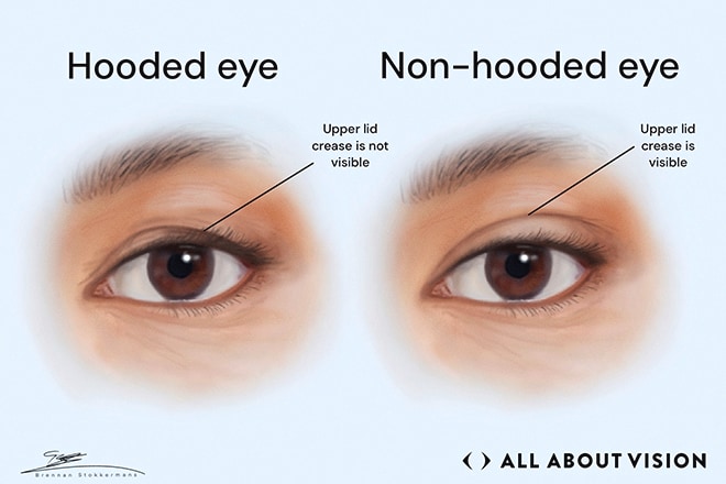 Hooded eyes Hooded eyes