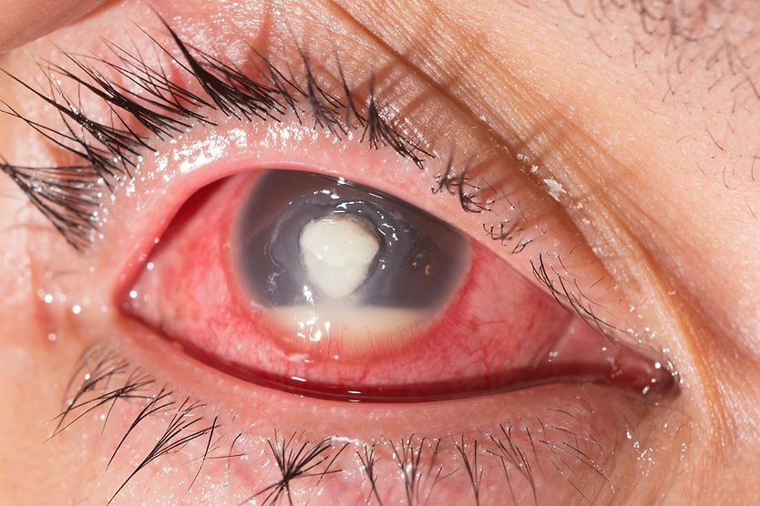 closeup of an eye with hypopyon