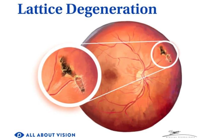 Medical illustration of lattice degeneration of the eye.