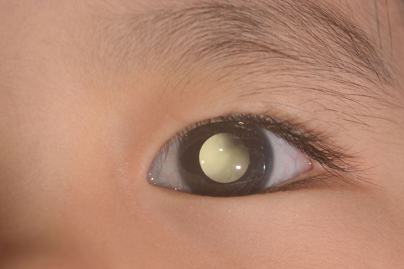 closeup of a child's eye with leukocoria
