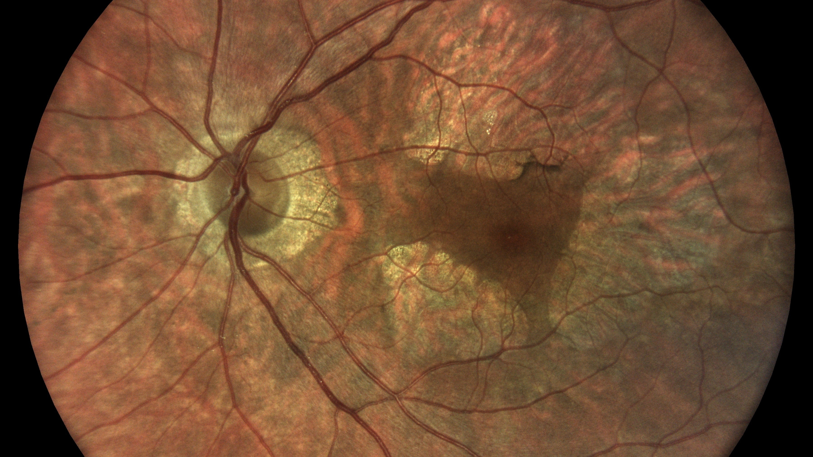 Congenital macular dystrophy on the left eye