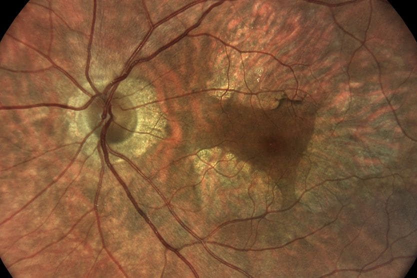 Congenital macular dystrophy on the left eye