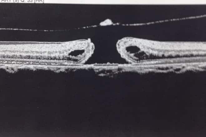 real image of a macular hole
