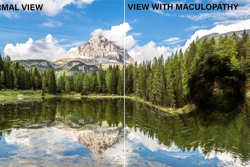 side by side mountain view of normal vision vs vision with maculopathy