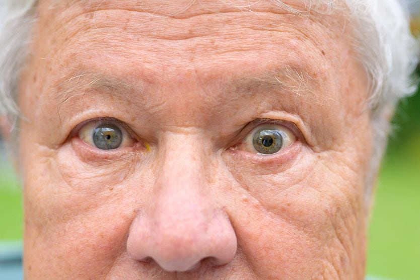 Photo depiction of a person with Marcus Gunn Pupil