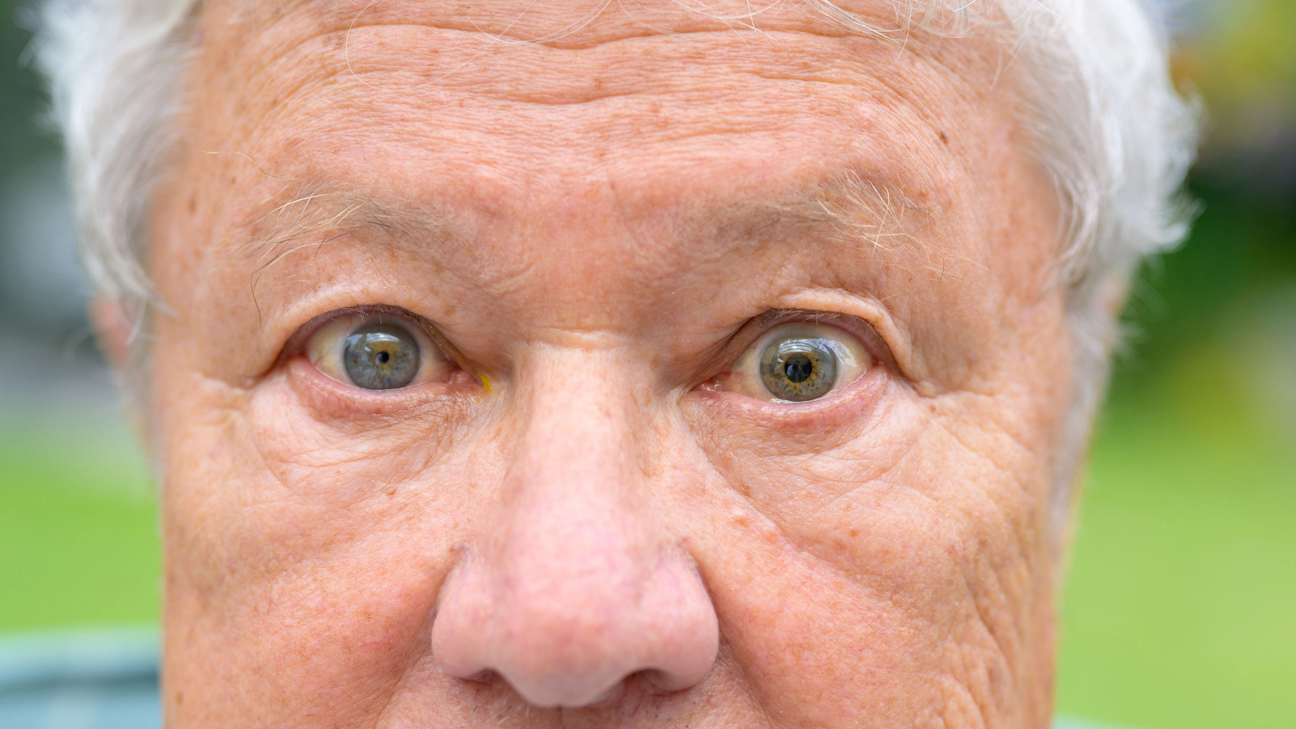 Photo depiction of a person with Marcus Gunn Pupil