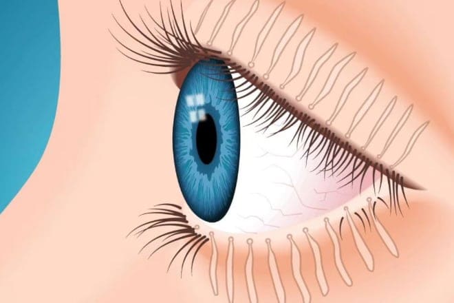 Meibomian Gland Dysfunction Meibomian gland dysfunction