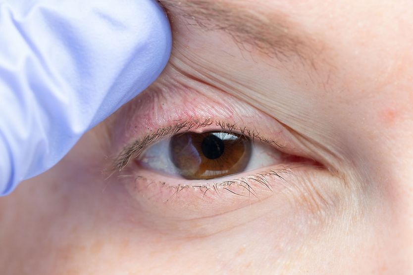 Meibomian gland dysfunction