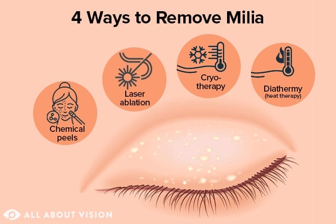 Milia on your eyelid? What milia are and how to remove them