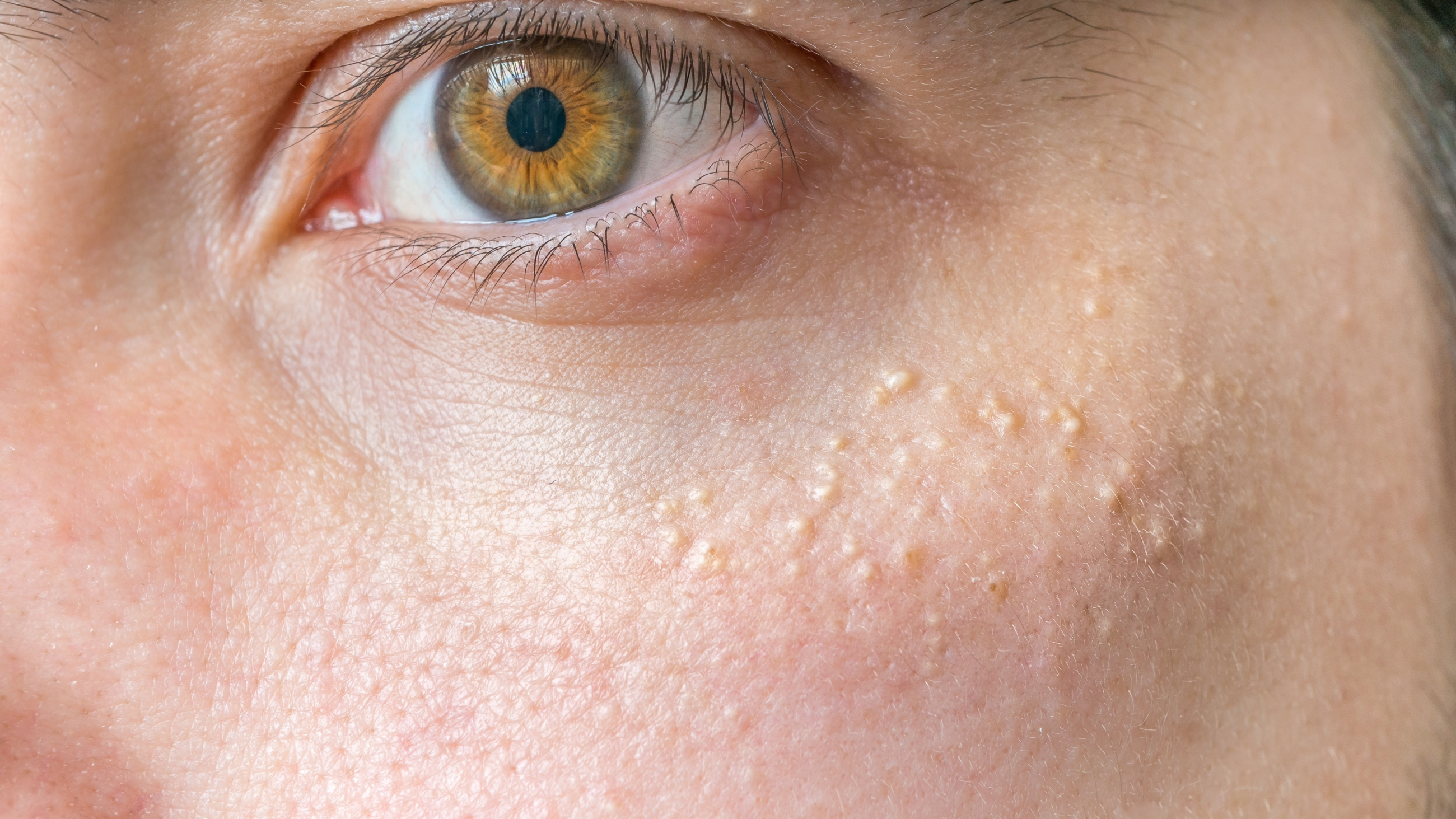 closeup of milia bumps on cheek below the eye