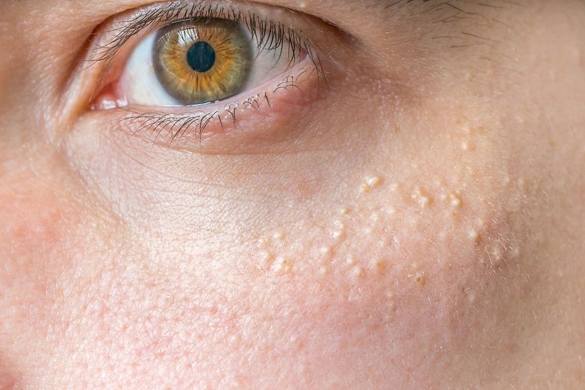 closeup of milia bumps on cheek below the eye