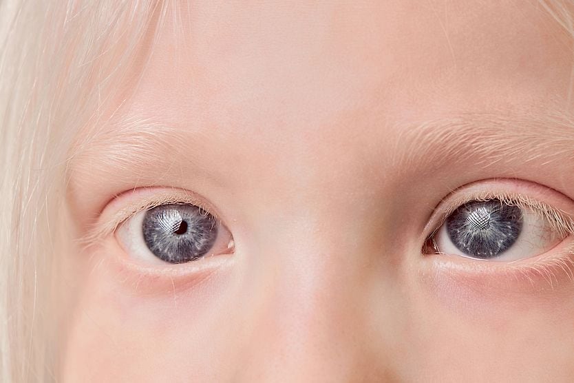 young girl's eyes with ocular albinism