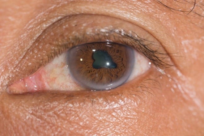 Woman holding eye in pain