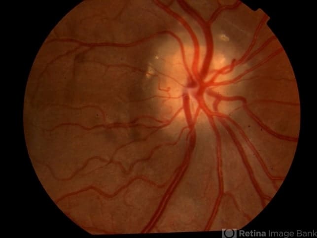 Optic nerve drusen: Symptoms, causes and treatment