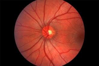 Optic neuritis and neuropathy: Symptoms, causes, treatments Optic neuritis and neuropathy: Symptoms, causes, treatments