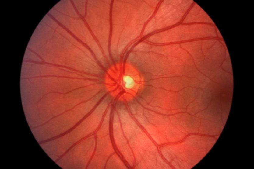 Optic neuritis and neuropathy: Symptoms, causes, treatments Image of the back of a healthy eye