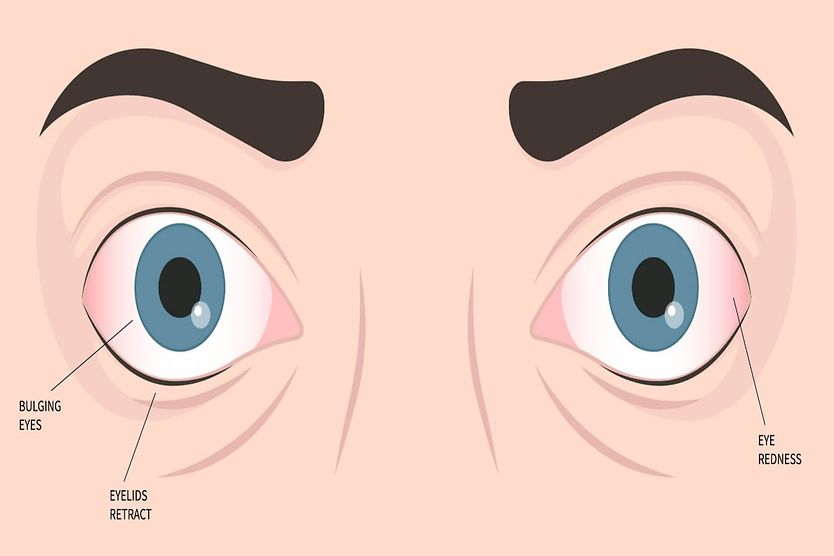 Characteristics of orbital pseudotumor include bulging eyes, eye redness, and retracted eyelids. 