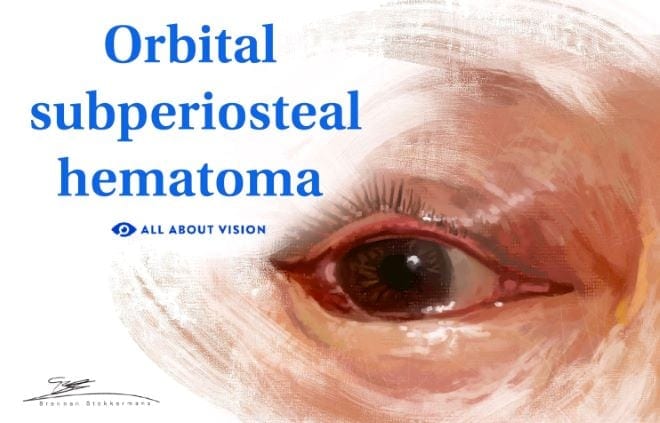 Orbital subperiosteal hematoma