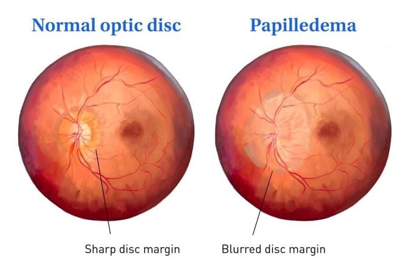 Papilledema (optic disc swelling) Diagram of Papilledema