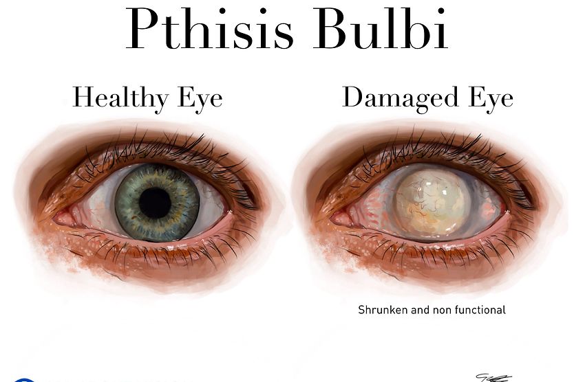 Phthisis bulbi Phthisis bulbi occurs when damage to the eye causes it to completely stop working.