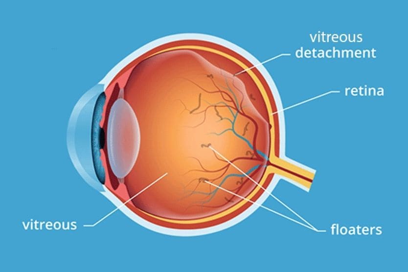 Posterior vitreous detachment illustration of an eyeball with vitreous detachment