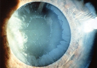 Pseudoexfoliation syndrome and pseudoexfoliation glaucoma: Causes, symptoms and treatment Pseudoexfoliation syndrome and pseudoexfoliation glaucoma: Causes, symptoms and treatment