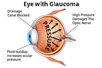 Pseudoexfoliation syndrome and pseudoexfoliation glaucoma: Causes, symptoms and treatment Pseudoexfoliation syndrome and pseudoexfoliation glaucoma: Causes, symptoms and treatment