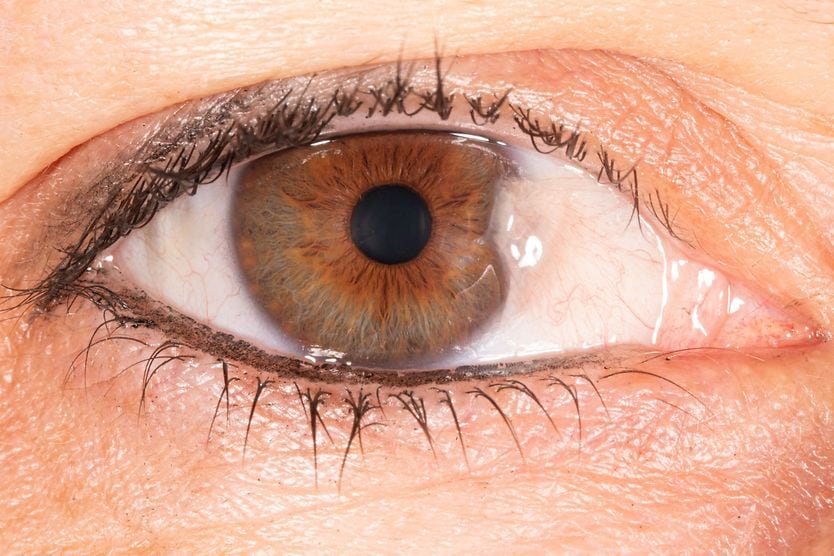 Pterygium close up
