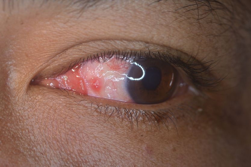 Pyogenic granuloma close up of eye