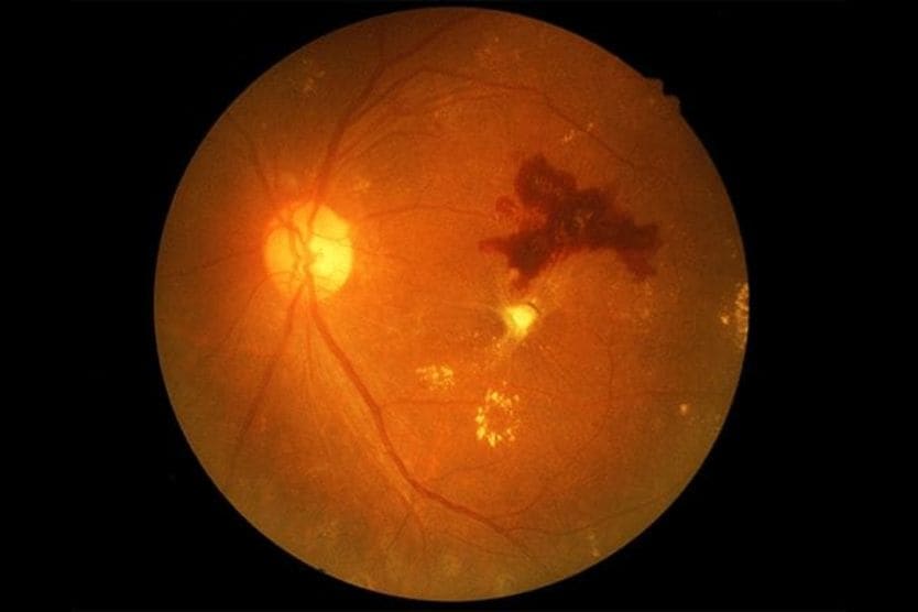 Retinal hemorrhage and retinal bleeding retinal hemorrhage