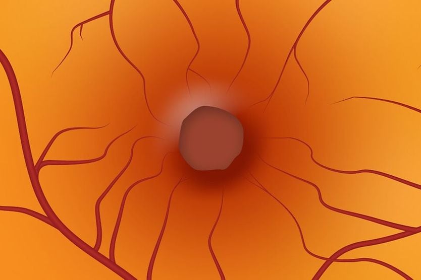 Retinal hole: Is it serious? Illustration of a macular hole