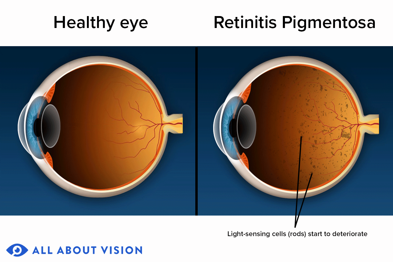 Retinitis pigmentosa