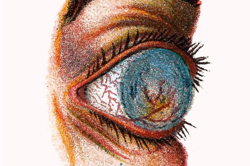 Staphyloma Illustration of the eye diseases Staphyloma