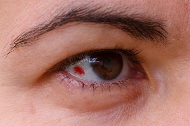 man with a subconjunctival hemorrhage