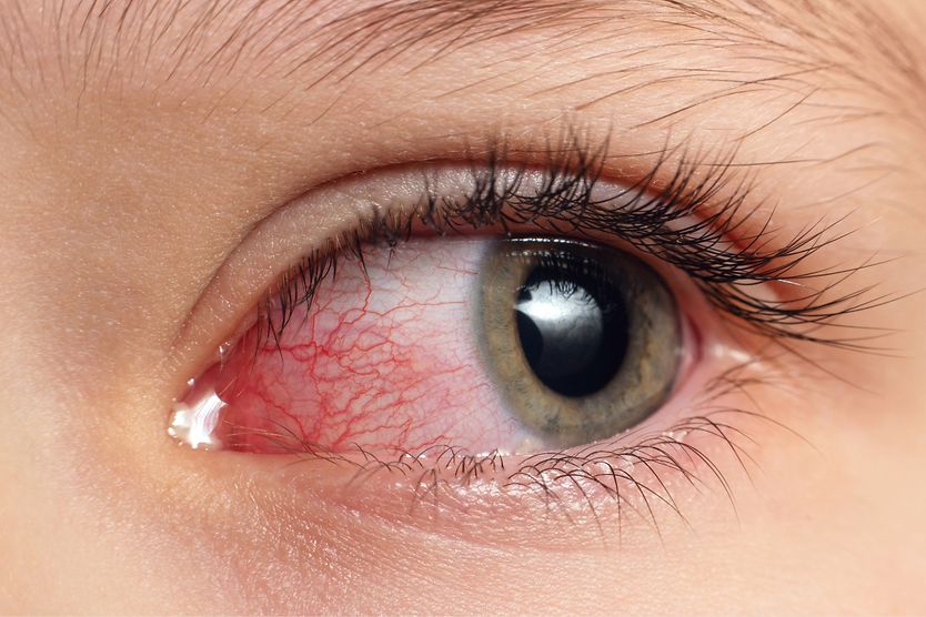 Is it bad to open your eyes in the pool? Pink eye irritation from chlorine