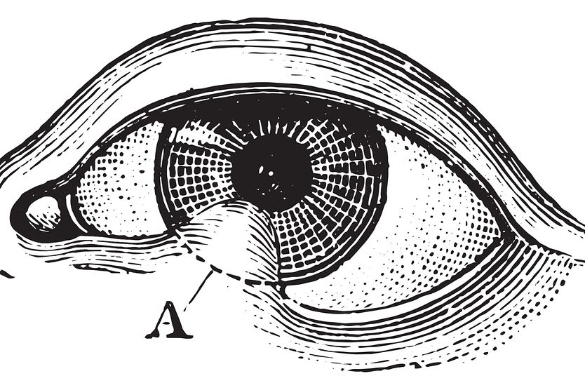 Symblepharon Medical illustration of symblepharons of the eye