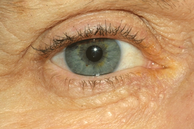 Syringoma
