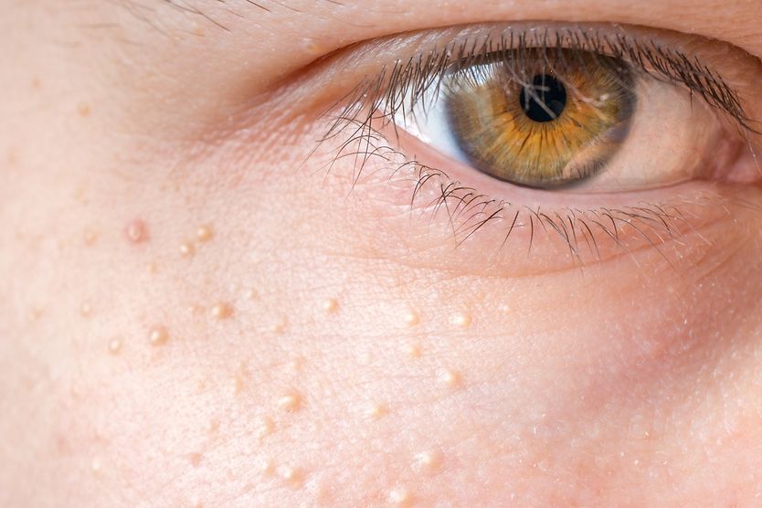 Syringoma closeup under eye with syringoma