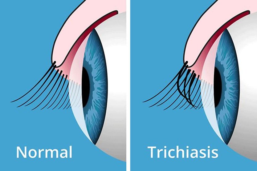 Trichiasis (ingrown eyelashes): Causes, symptoms and treatment illustration sideview of a normal eye vs an eye with trichiasis