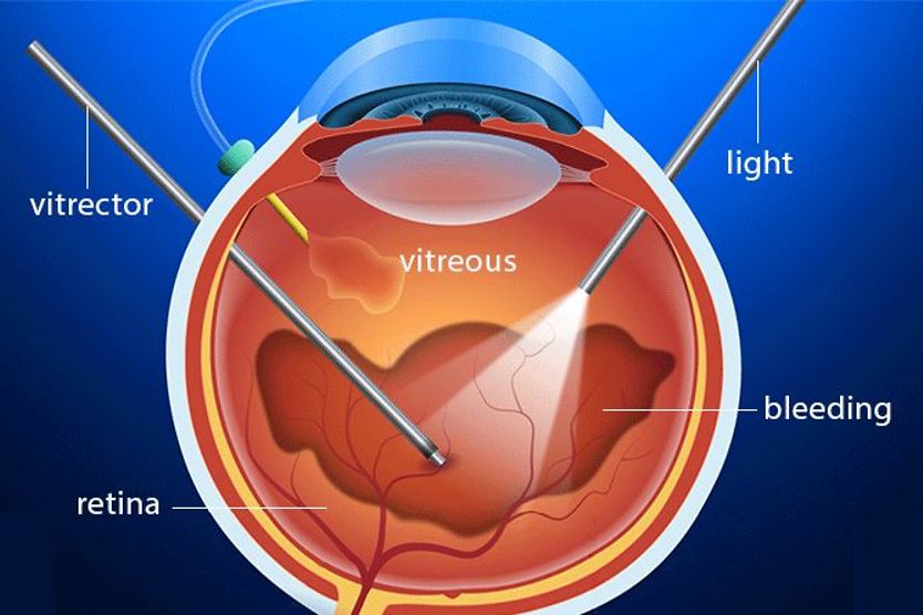 vitreoretinal procedure after vitreous hemorrhage