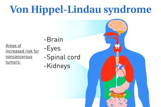 Von Hippel-Lindau syndrome and its impact on vision
