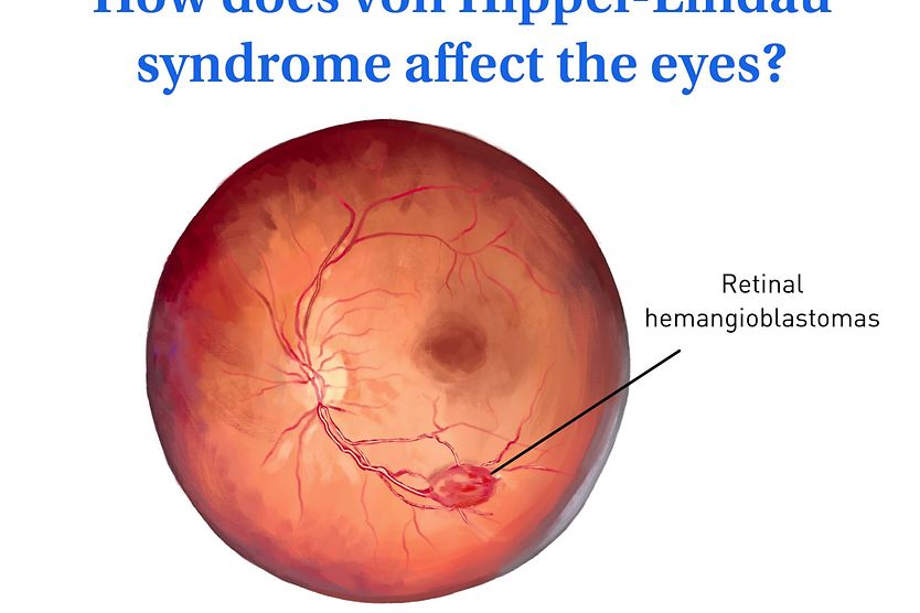Learn how von Hippel-Lindau syndrome affects the eyes, what symptoms to watch for, and how doctors diagnose and treat this condition.