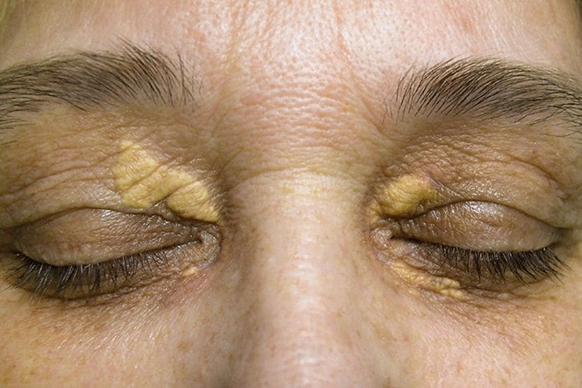 Xanthelasma: Causes, treatment and risk factors closeup of eyes with xanthelasma