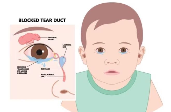 Clogged tear ducts in a baby: Causes, symptoms and treatment