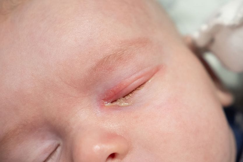 Clogged tear ducts in a baby: Causes, symptoms and treatment