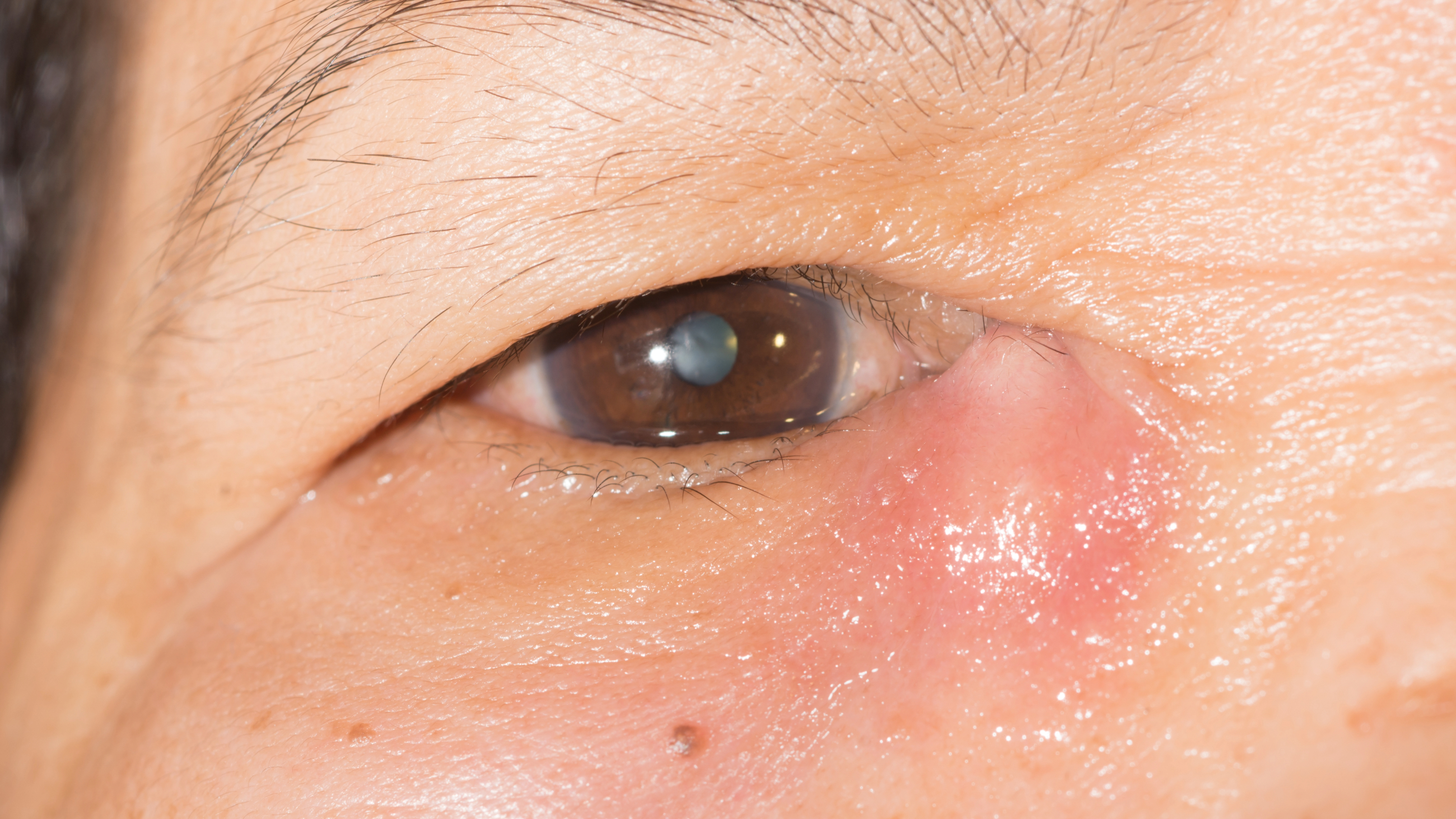 closeup of an eye with dacryocystitis (tear duct infection)