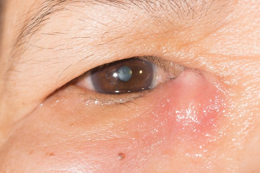 Dacryocystitis: Causes, symptoms and treatments closeup of an eye with dacryocystitis (tear duct infection)