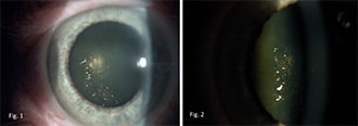 What are Christmas tree cataracts?