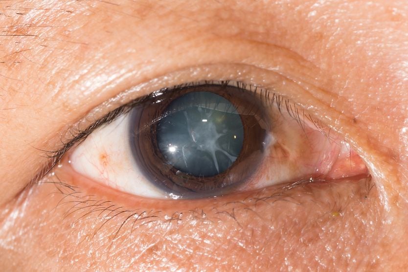 Cortical cataract: Description and causes closeup of elderly man with cortical cataracts