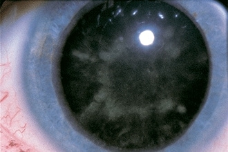 What are snowflake (diabetic) cataracts?